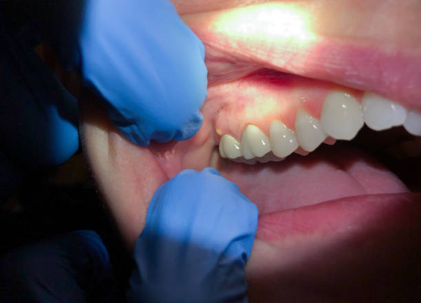 Best Emergency Wisdom Teeth Removal in Santa Barbara, CA