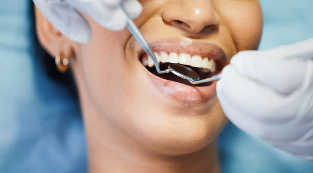 Best Emergency Wisdom Teeth Removal in Santa Barbara, CA